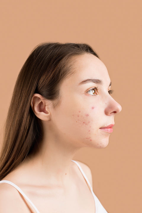 Close-up profile showing natural acne-prone skin texture