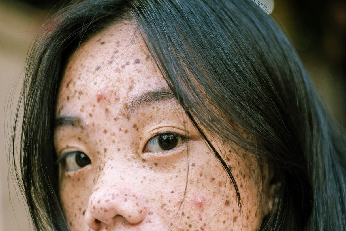 Why Dark Spots Form and How Pigmentation Creams Work