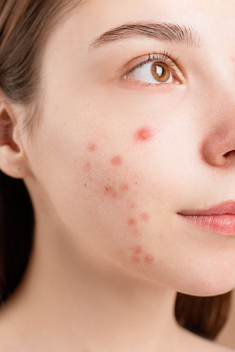 Natural close-up facial skin with blemishes. Photo: Hanna Pad via Pexels.