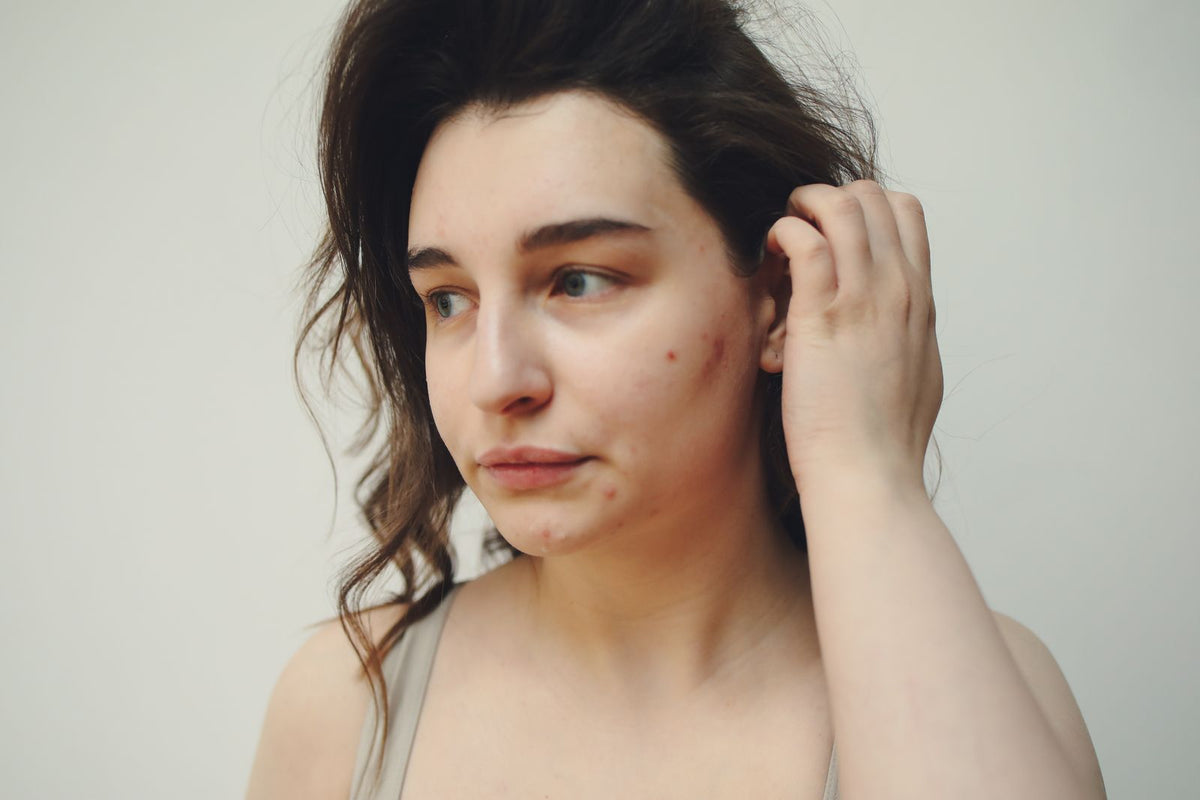 Natural skin with acne marks. Photo: Polina Tankilevitch via Pexels.