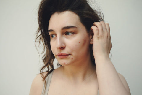 Natural skin with acne marks. Photo: Polina Tankilevitch via Pexels.