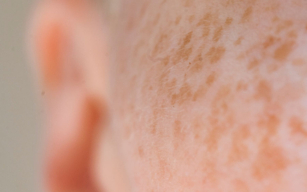 Why Dark Spots Come Back After Fading: What to Change
