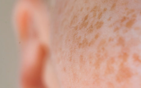 Natural close-up of freckles and real skin texture on a woman's face, for an article about recurring pigmentation. Pexels: Angela Roma.